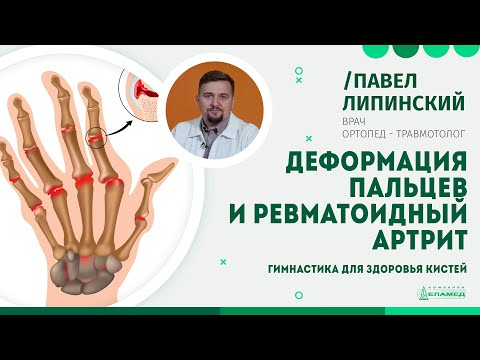 Деформация пальцев и ревматоидный артрит. Гимнастика для здоровья кистей | Павел Липинский
