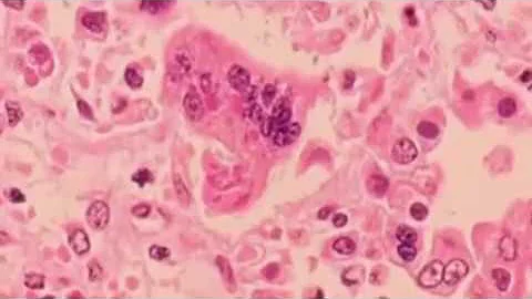 Measles outbreak nearing largest in two decades