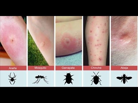 Vídeo: Mordida De Viúva Marrom: Sintomas, Tratamento, Prevenção, Fotos