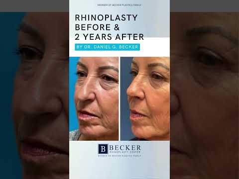 Video thumbnail: Rhinoplasty 2 Years Later and Still Looks Right 👃😌 | Dr. Daniel Becker · Becker Rhinoplasty Center
