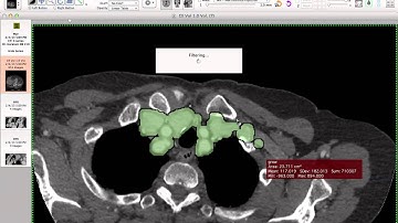 Aortic Segmentation - How i do it with Osirix