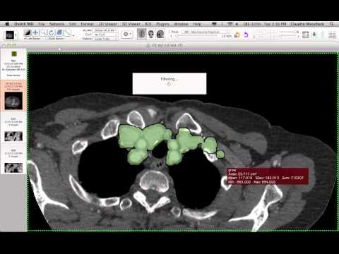 Aortic Segmentation - How i do it with Osirix