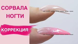 Подралась с парнем | Сложная коррекция ногтей на вниз растущие ногти