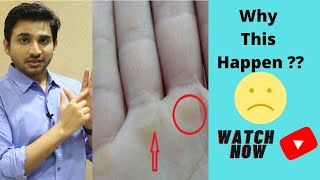 Hard skin on palm of hand |  How To Fix Calluses | The Overcompensation Principle |  BreatheFit TV screenshot 4