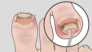 ASMR Oddly satisfying Ingrown toenail removal animation / LULUPANG