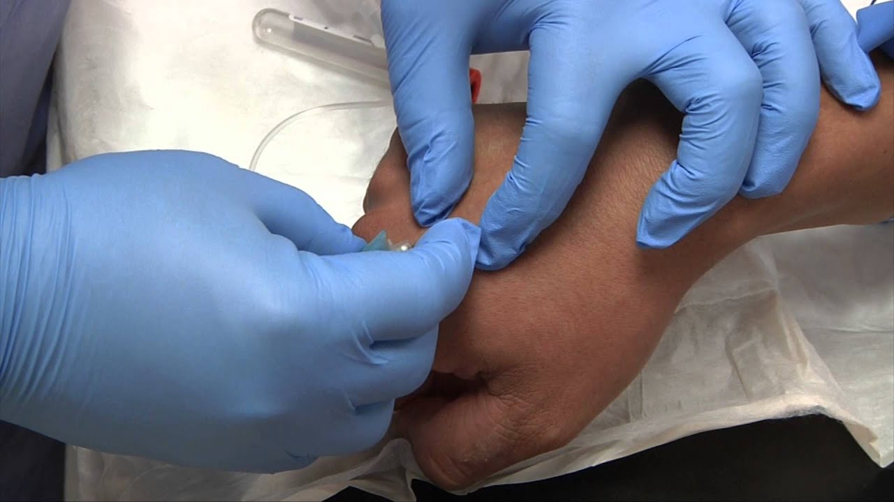 Performing a venipuncture using a butterfly needle 