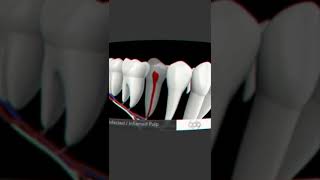 حشو عصب الأسنان التالف||فيديو قصير انيميشن