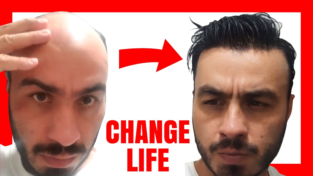 Protesi Capelli Come RITOCCARE Il Front HAIR SYSTEM Hairline Clean 