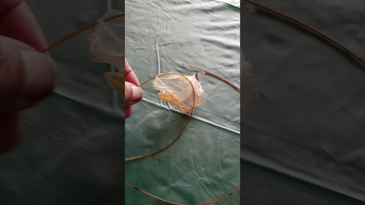 Pain pump removal At home YouTube