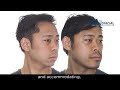 Jaw surgery case  101 kendrick  sleep apnea maxillomandibular retrusion