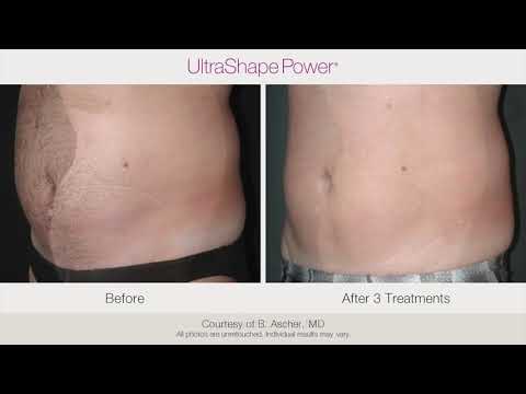 UltraShape & VelaShape Body-Contouring