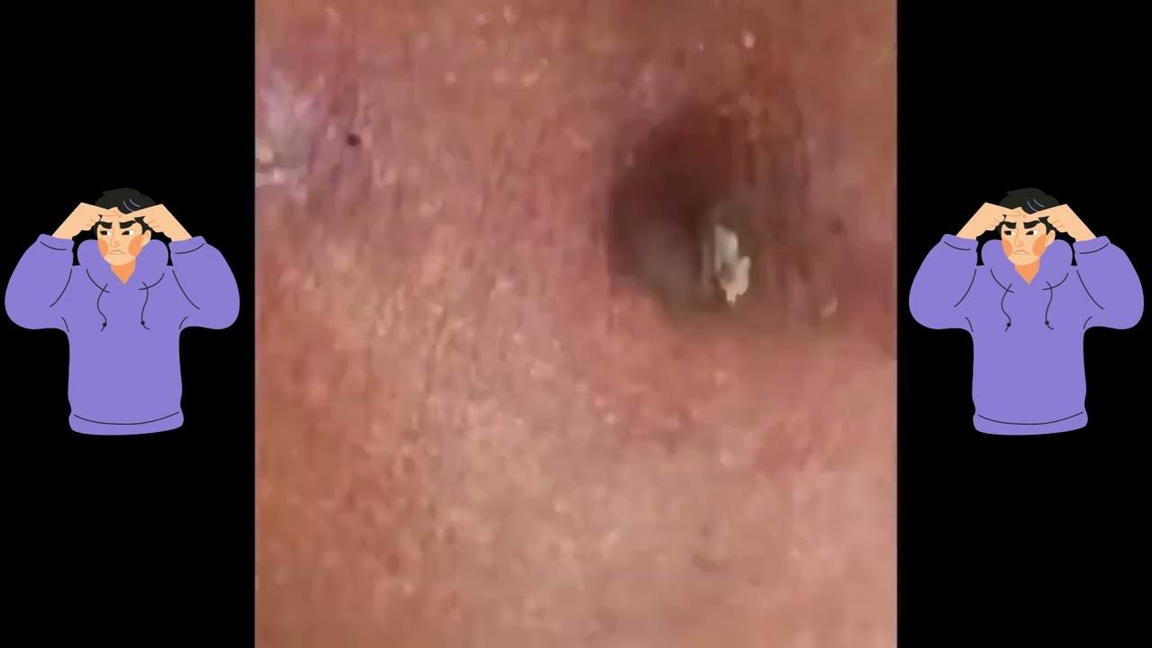 Disgusting blackhead removal YouTube