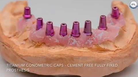 Basal implant Surgery, Impression and Provisional prosthesis with conometrics (video)