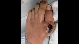 Septic Arthritis with Pus at the Big Toe Joint Surgery to Save the Toe