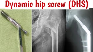 #Dynamic #hipscrew/# dynamiccondylar #screw/#orthopaedic implants#mbbs#exam