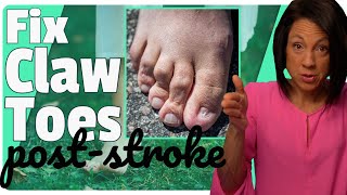 Secrets to Fixing Clenched Toes PostStroke