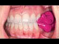 Occlusion Adjustment Dr Mostafa Taha Occlusion Adjustment Dr Mostafa Taha