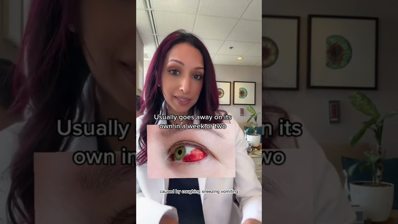 Did You Wake Up With Blood In Your Eye Doctor Explains Shorts Health Eyes