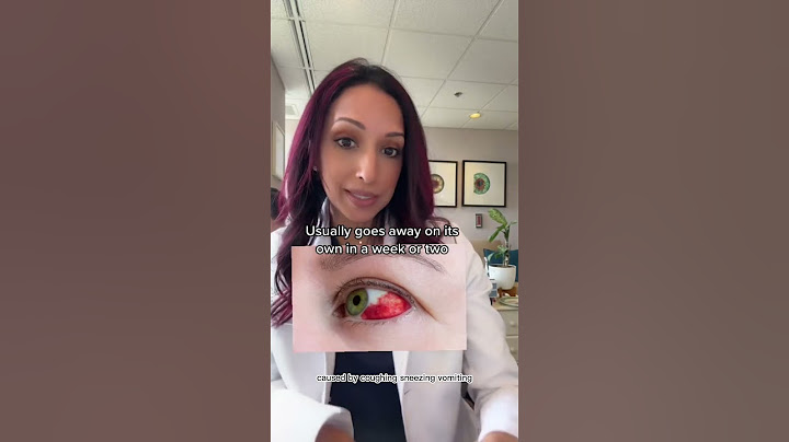 Did You Wake Up With Blood In Your Eye? | Eye Doctor Explains #shorts #health #eyes