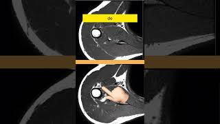 El bíceps causa dolor dentro del hombro ortopedista hombro artroscopia resonancia