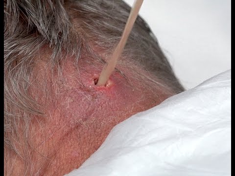 Scalp/Neck Abscess Final Follow-Up For Marathon Man!