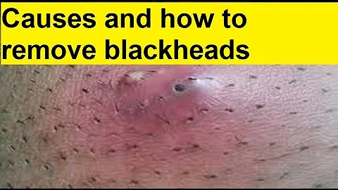 causes and how to remove blackheads