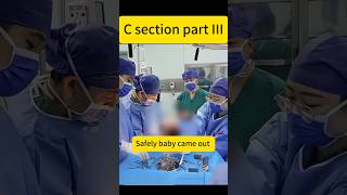 C section operation #motivation #babybehavior #duet