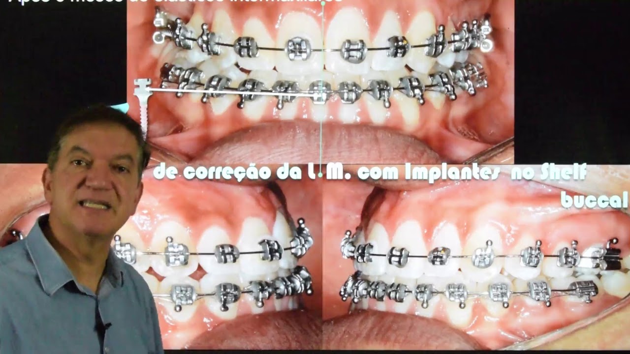 Correção da Linha Média - Prof. Dr. Pedro Andrade Jr