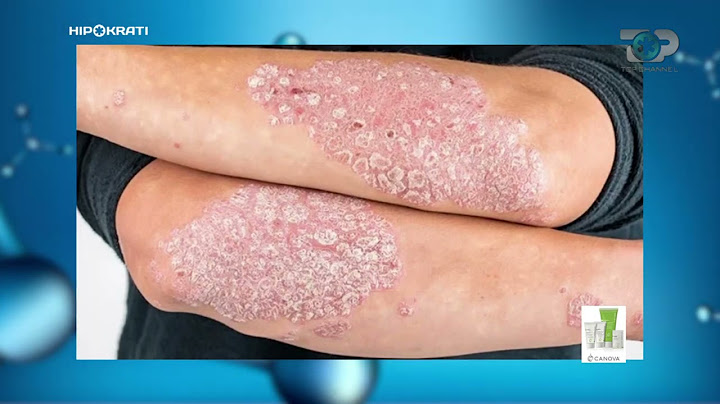 Hipokrati - Shkaktarët e Psoriazës! Mësojini dhe evitojini! 8 Janar 2022