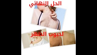 جربت وصفة صاروخية لإزالة حب الشباب من الظهر نهائياً !! (النتيجة سحرية)