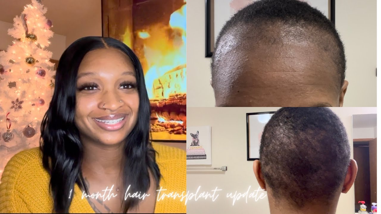 1 MONTH HAIR TRANSPLANT UPDATE | TURKEY LONGEVITA