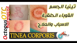 Tinea corporis |Ringworm | تينيا الجسم | القوباء الحلقية | الأعراض والعلاج والوقاية