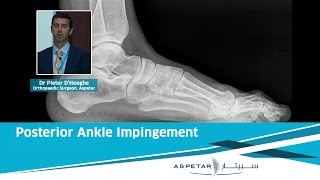 Posterior Ankle Impingement | Dr. Pieter D’Hooghe (Aspetar)