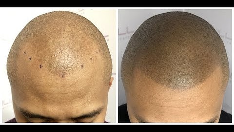 Heart Felt SMP Testimonial - FULL Micropigmentation - Las Vegas