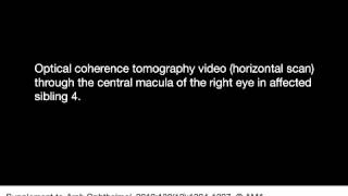 Optical Coherence Tomography in Sibling 4