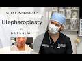33. Upper Eyelid Surgery Recovery: What to Expect After Blepharoplasty