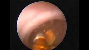 Lithotech Lithotripter - Video2