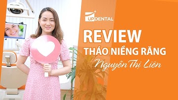 [Review niềng răng]: #2 Kết quả niềng răng móm của Liên