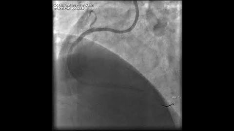 Complex PCI for RCA CTO with bifurcation at distal cap video 19