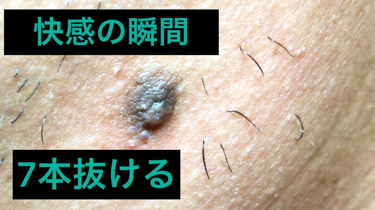 神回!抜けまくるほくろの毛 YouTube 神回!抜けまくるほくろの毛 YouTube