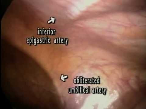 Pelvic Anatomy by Laparoscopy