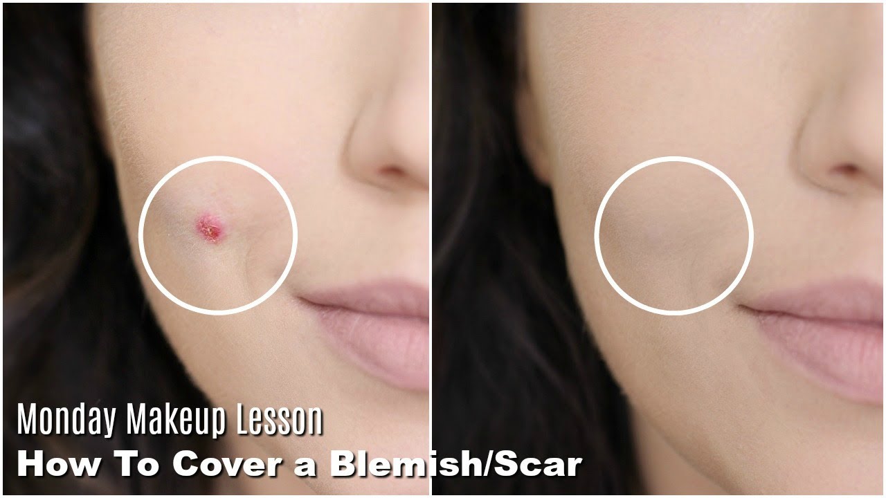 How To Er Acne Scars Blemishes