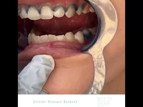 Sbiancamento Dentale - Clinica Dentale Biodent