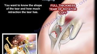 Rotator Cuff tear  Imaging - Everything You Need To Know - Dr. Nabil Ebraheim