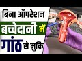5 Steps to Shrink Fibroids | Fibroids को करें Shrink Naturally Without Surgery | Fibroid Treatment