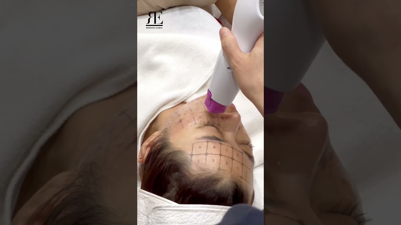 Thermage FLX treatment in Korea  