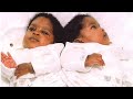 Этих сиамских близнецов разделили в младенчестве, посмотрите какими они стали спустя 20 лет.
