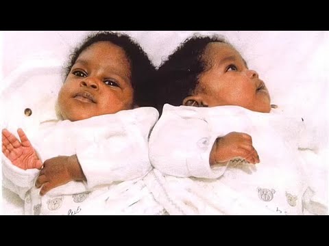 Видео: Этих сиамских близнецов разделили в младенчестве, посмотрите какими они стали спустя 20 лет.