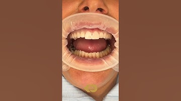 Composite Veneers Process #shorts