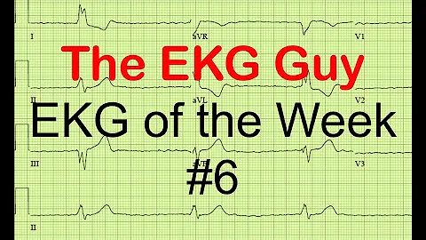 EKG/ECG of the Week #6 | The EKG Guy - www.ekg.md